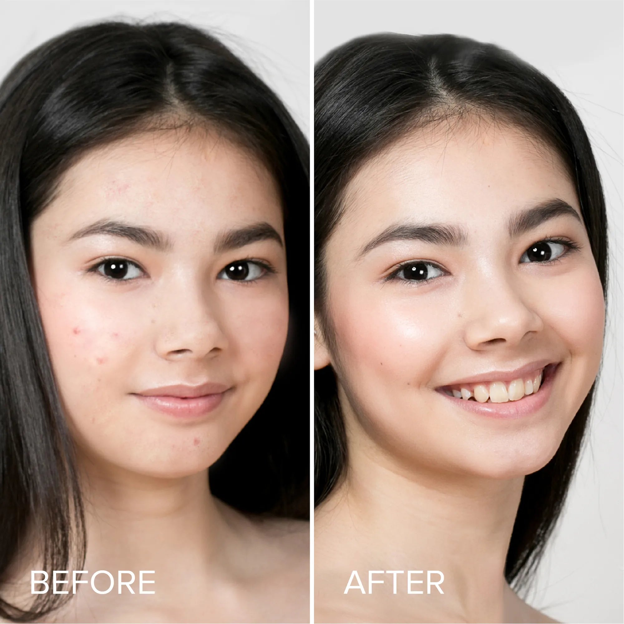 Pimple & Acne Patches — Clear Blemishes Overnight, No Popping!